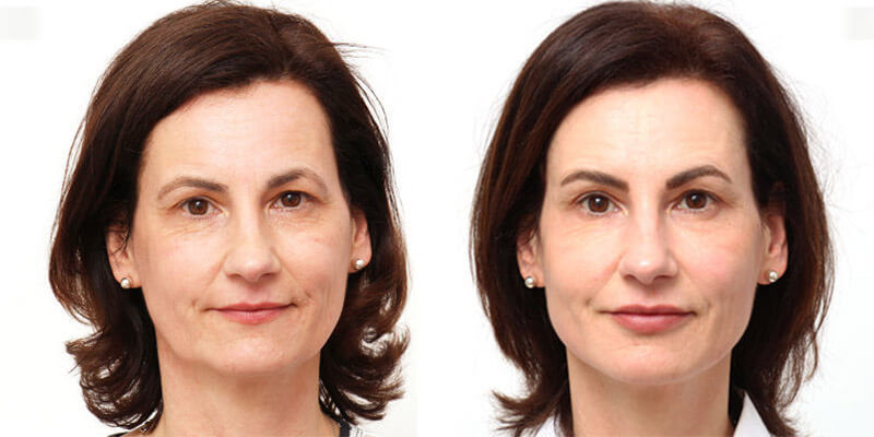 FACIAL DESIGN vs. Facelifting