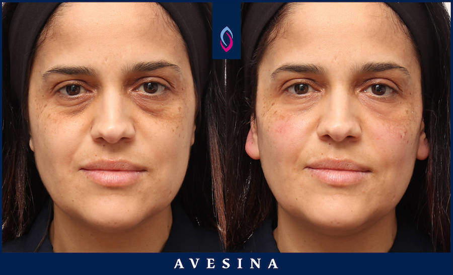 Vorher-Nachher Bild einer dunkelhaarigen älteren Frau nach einer Facial Design Behandlung