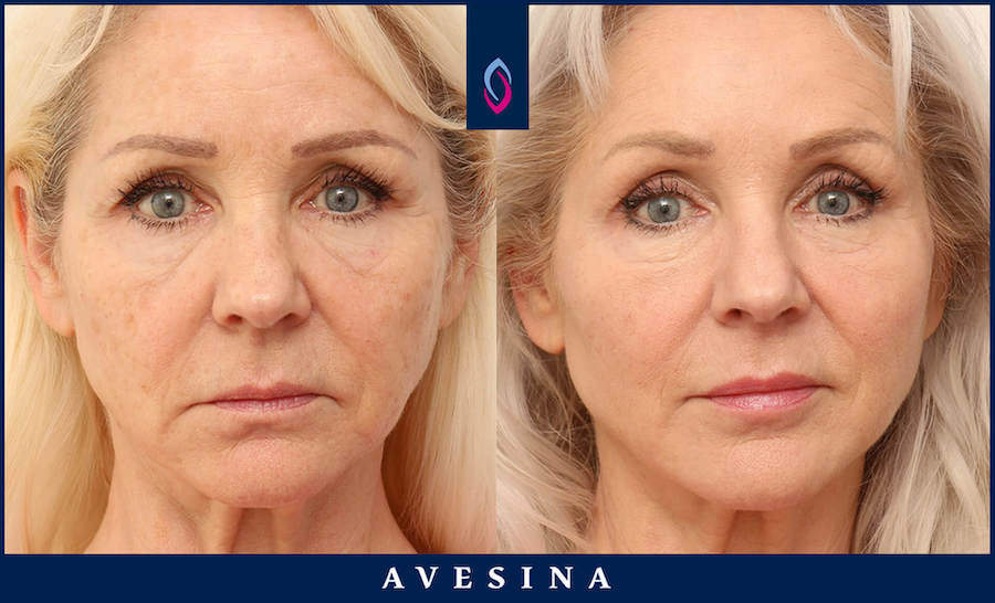 Vorher-Nachher Bild einer blonden älteren Frau nach einer Facial Design Behandlung