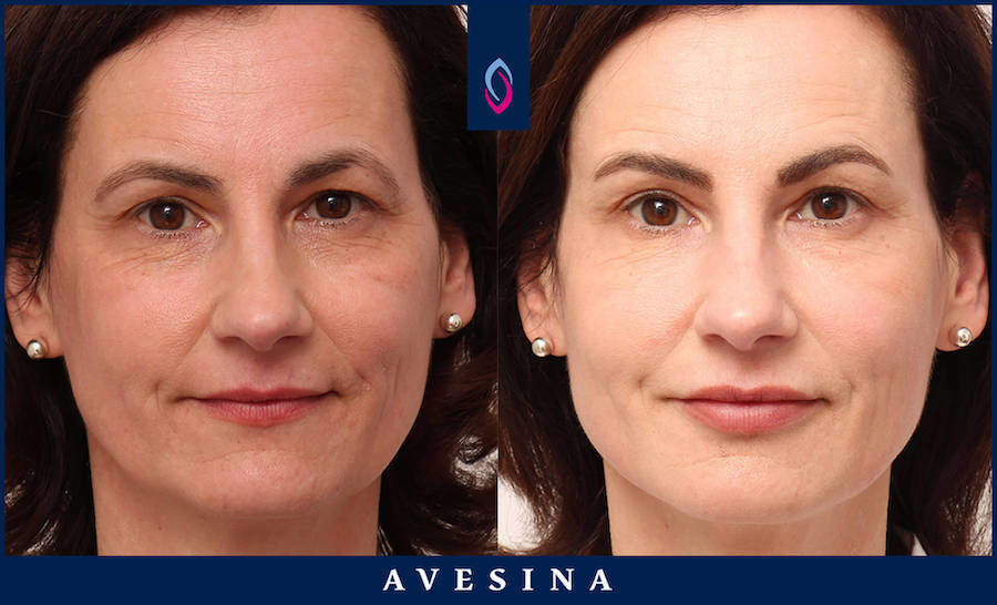 Vorher-Nachher Bild einer dunkelhaarigen Frau mittleren Alters nach der Facial Design Behandlung