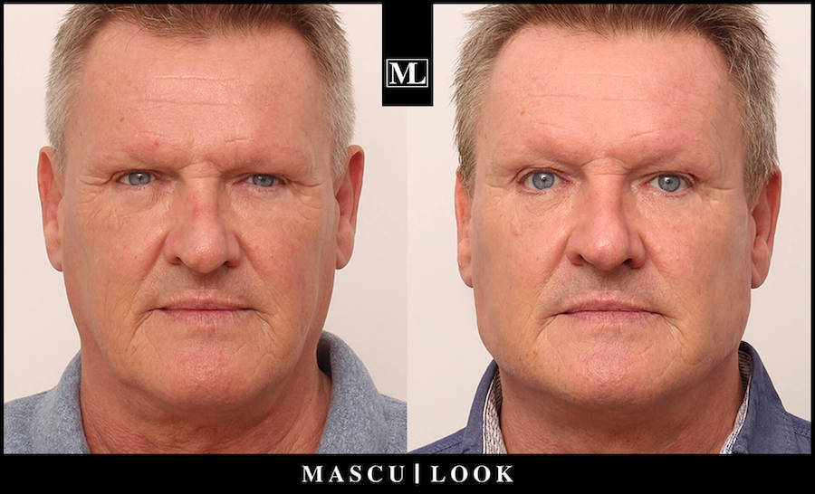 Vorher-Nachher Bild eines älteren Mannes nach einer Masculook Behandlung