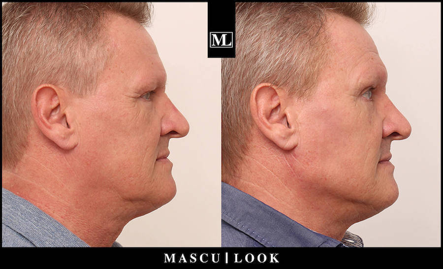Vorher-Nachher Bild eines älteren Mannes nach einer Masculook Behandlung