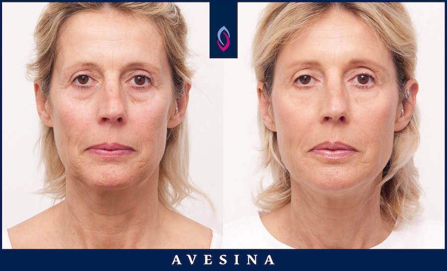 Vorher-Nachher Bild einer blonden älteren Frau nach der Facial Design Behandlung