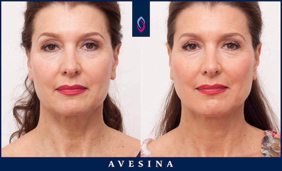 Facial Design Dr. Djalaei - düsseldoVorher-Nachher Bild einer dunkelhaarigen älteren Frau nach der Facial Design Behandlungrf - d-aesthetic