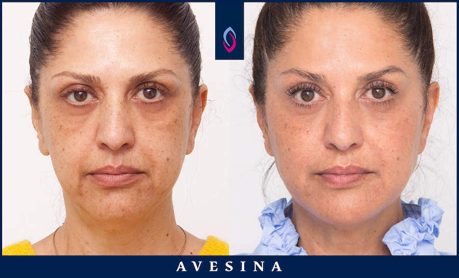 Vorher-Nachher Bild einer dunkelhaarigen älteren Frau nach der Facial Design Behandlung