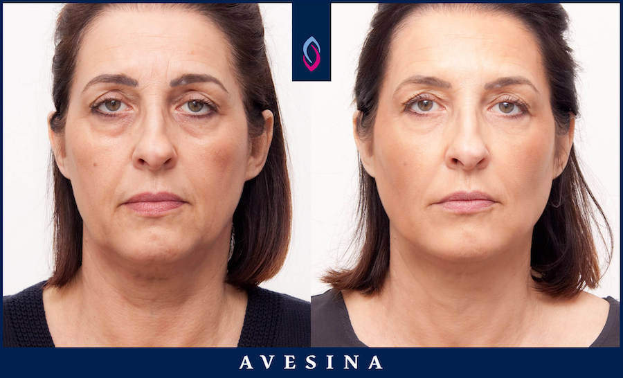 Vorher-Nachher Bild einer dunkelhaarigen älteren Frau nach der Facial Design Behandlung