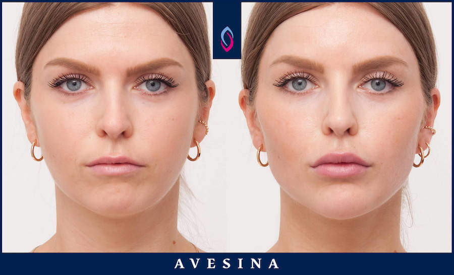 Vorher-Nachher Bild einer brünetten jüngeren Frau nach der Facial Design Behandlung