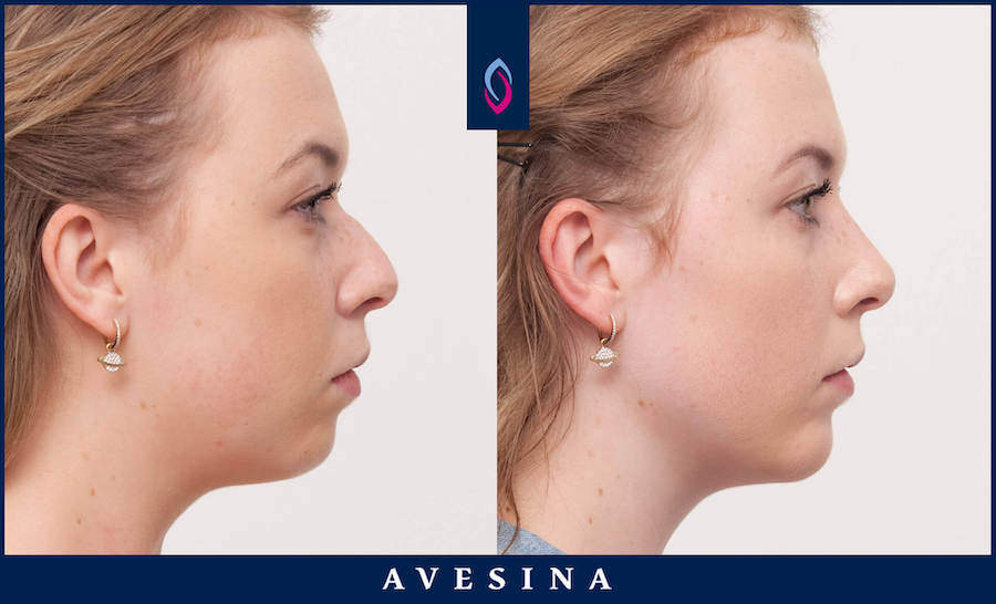 Vorher-Nachher Bild einer brünetten jüngeren Frau nach der Nasenkorrektur ohne OP